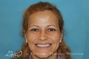 Cosmetic Dentistry Before & After Photos Houston TX | Smile Gallery